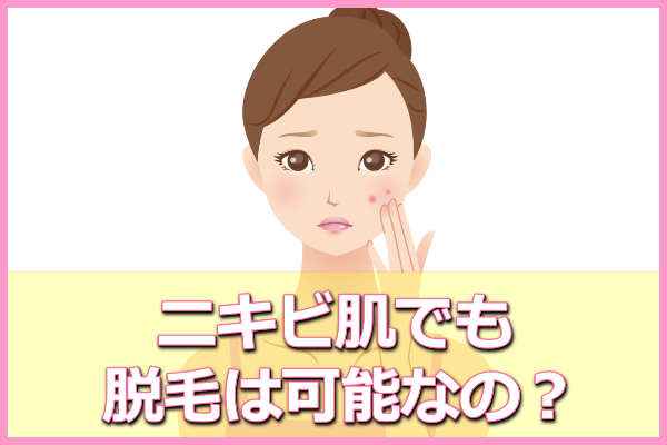顔にニキビがあるのに顔脱毛は可能？治るって噂も…